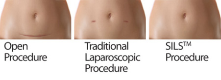 Single Incision Laparoscopic Surgery [SILS]